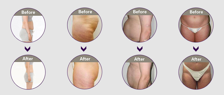 Multi-function Cryolipolysis Slimming Machine US09