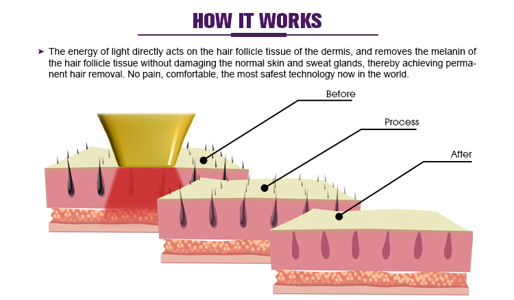 755 808 1064 Depilation Laser Hair Removal Machine US425