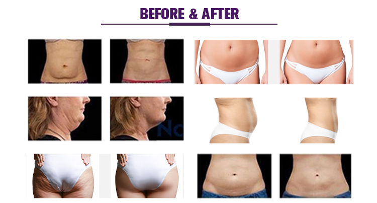 Fat Freezing Weight Loss Cryolipolysis Body Slimming Machine US601N-4