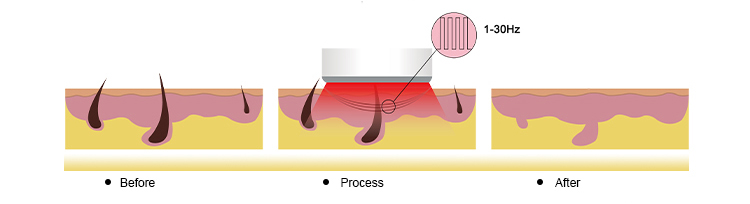 hair removal theory