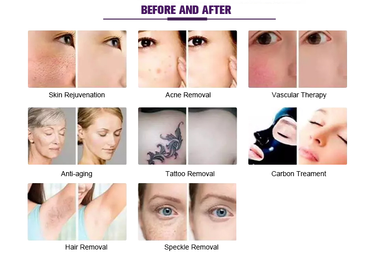 IPL RF E-Light YAG Laser Beauty Equipment US0020H