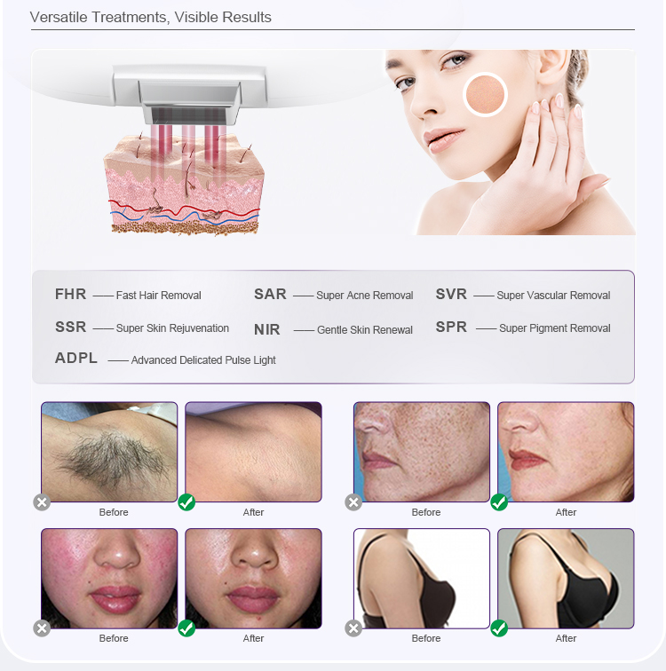 IPL Hair Removal Dpl Skin Care Beauty Machine US0030F