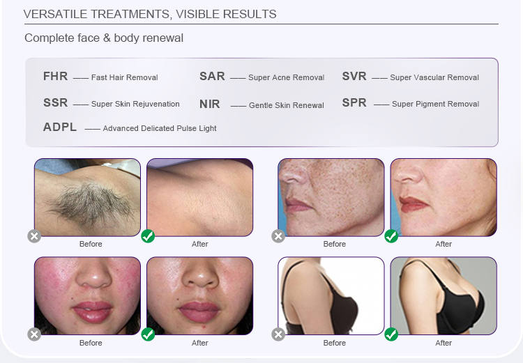 IPL Optional Skin Care Machine US6120F