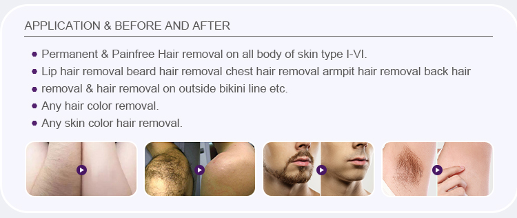 755 808 1064nm Diode Laser Hair Removal Machine US4500