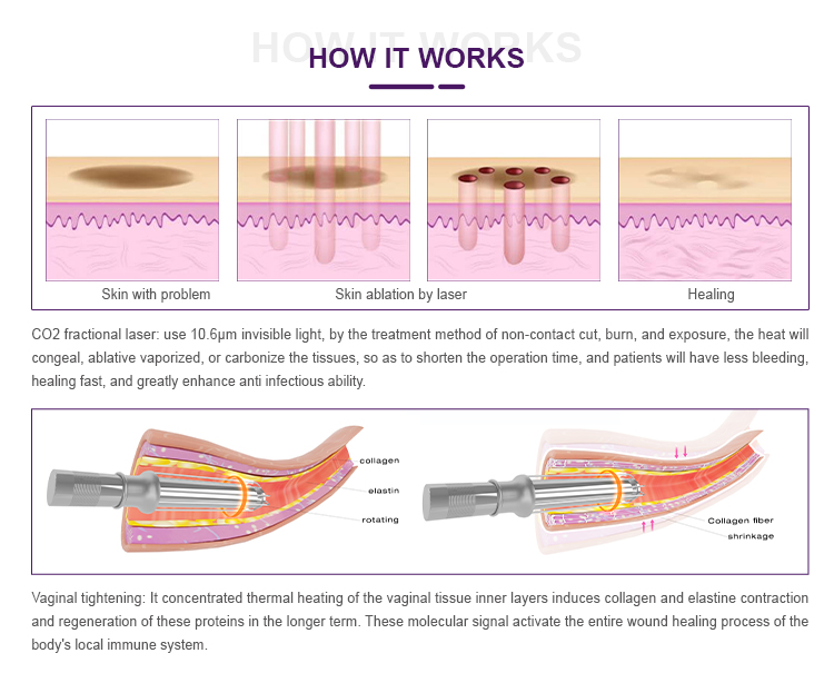 Painless Laser CO2 Vaginal Machine US8000