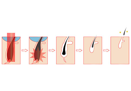 Fiber Diode Laser Working Principle