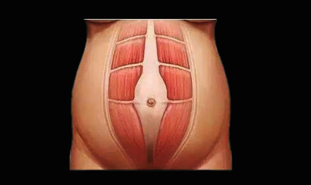 Treatment the Separation of Rectus Abdominis