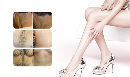 IPL Hair Removal