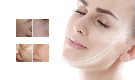 IPL Skin Rejuvenation