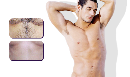 Chest Hair Removal