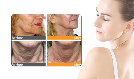 Removing Neck Wrinkles