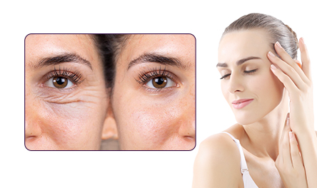 Remove Wrinkles Around Eyes