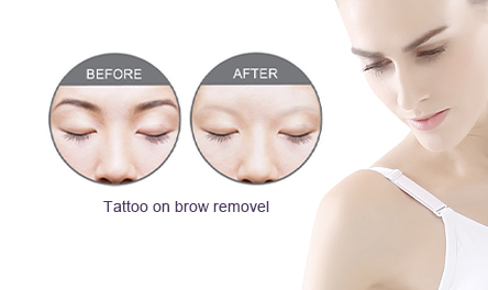 Tattoo on Brow Remove