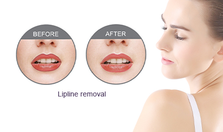 Lipline Removal