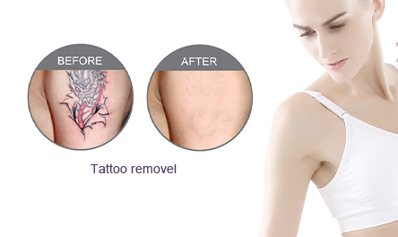 Tattoo Removal