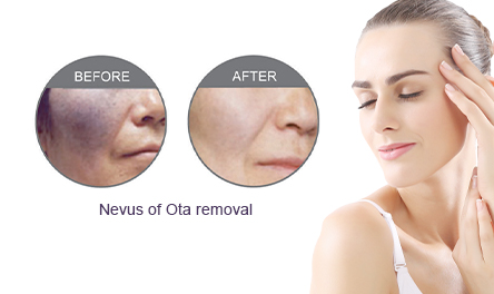 Nevus of Ota Removal