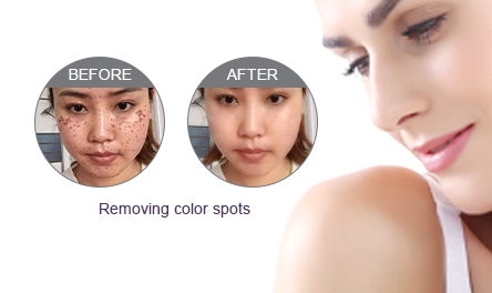 Removing Color Spots