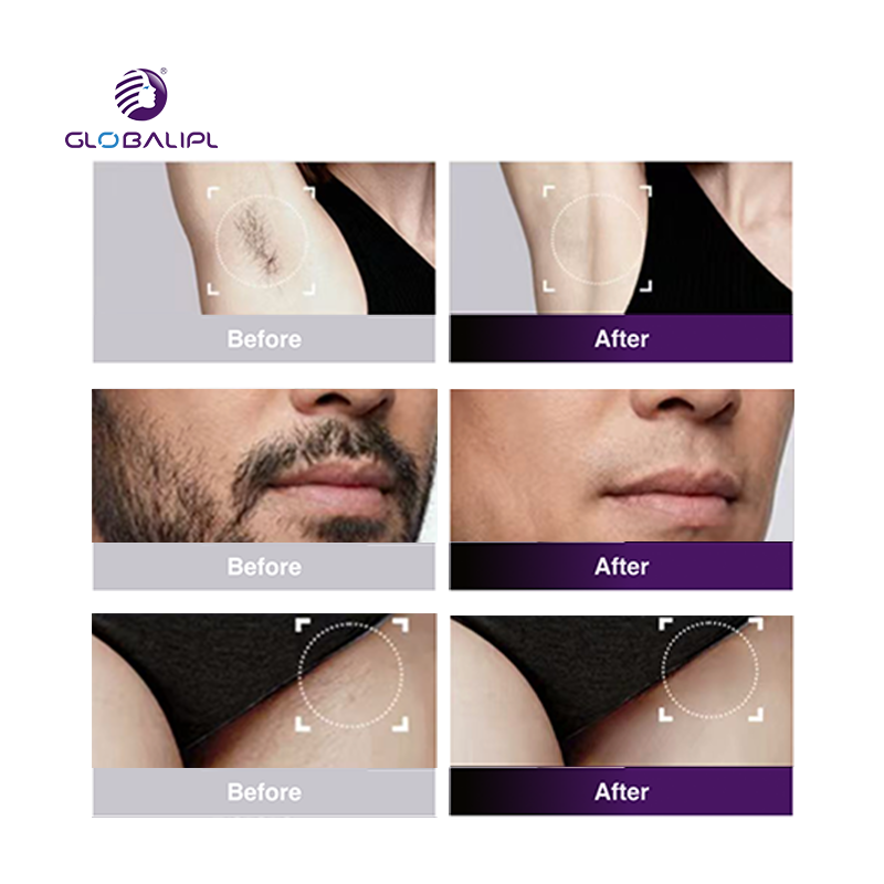 How Diode Laser Ensures Safe & Effective Hair Removal